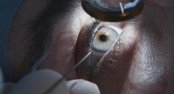 Things You Need to Know About Cataract Surgery